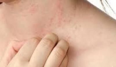 أخبار اليمن : الكشف عن فائدة غريبة لـ”حب الشباب”