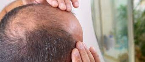 وداعاً للصلع محلول سحري في كل منزل يساعد على إنبات الشعر خلال أسبوع واحد.. جربه بنفسك ولا تتردد