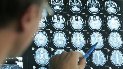 علامات تدل على الجلطة الدماغية