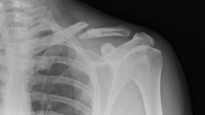 أخبار اليمن : فئات الأشخاص الأكثر عرضة للإصابة بهشاشة العظام