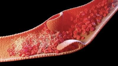 ثلاثة أعراض مقلقة لتخثر الدم