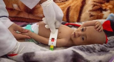 أخبار اليمن : 4 ملايين طفل يمني يعانون من سوء التغذية الحاد