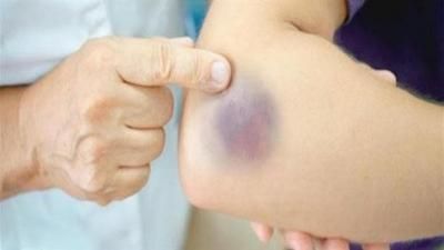 عاملٌ يزيد من خطر الإصابة بتجلّط الدم