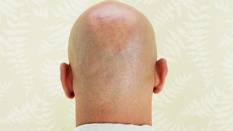 علاج متوفر بكل الصيدليات يقضي على الصلع نهائياً !.. ماهو