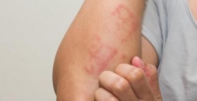 بشرتك "تكشف" إصابتك بأمراض خفية