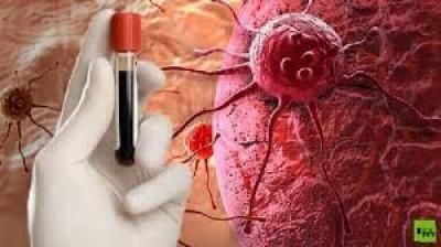 أخبار اليمن : كيف يمكن تجنُّب الإصابة بالسرطان؟