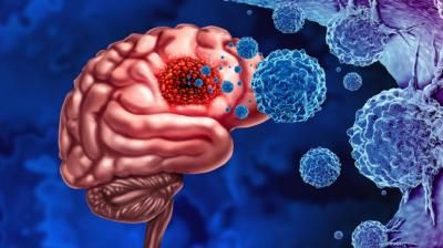 علاج واعد لسرطان الدماغ
