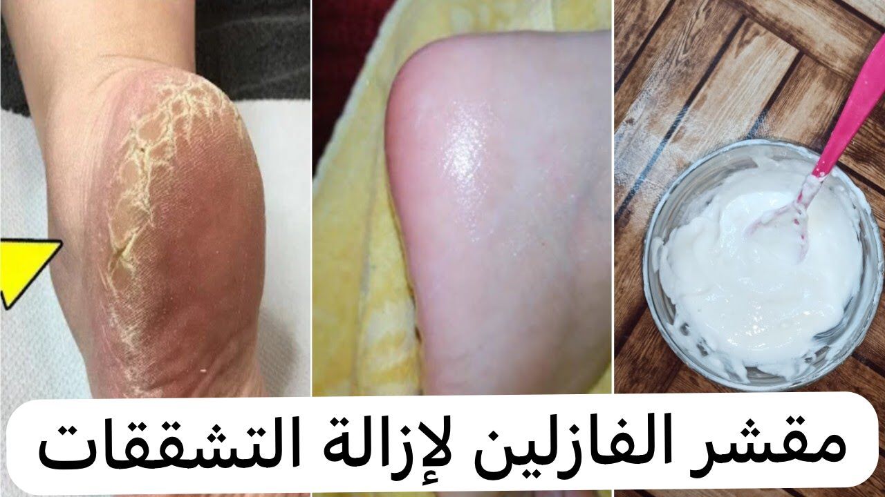 شاهد .. كعب رجلك هيبقي قشطة.. لو عندك فازلين هاتيه وتعالي أقولك أزاي تزيلي القشور والجلد الميت في دقائق