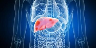 خطورة تشحم الكبد!