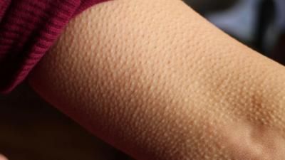 احذروا.. القشعريرة قد تشير إلى مرض خطير