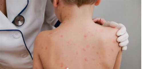 أبرزها الطفح الجلدي .. تعرف على أعراض جدري القرود