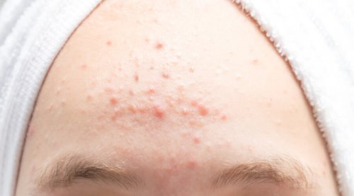 تعرف على أنواع حبوب الجبهة وكيفية التخلص منها