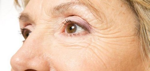 علاجات متاحة للتخلص من خطوط العين ونصائح للتخلص من علامات الشيخوخة حول العين.. تعرف عليها