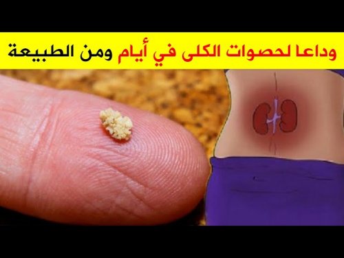 «طرق للوقاية من الإصابة بحصى الكل»..من الآن قل وداعا لحصى الكلى في 4 أيام فقط
