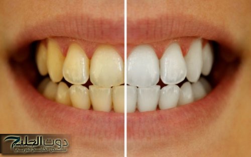 انسي اصفرار الاسنان بعد النهاردة!!... طرق فعالة ومجربة ومضمونة 100% للتخلص من بقع الاسنان نهائيًا