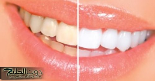«ما تتكسفيش تبيني اسنانك..!!» تاني طريقة طبيعية ورائعه لتبييض وتفتيح الاسنان وازالة البقع الصفراء في وقت قياسي.. نوري الدنيا بضحكتك..!!