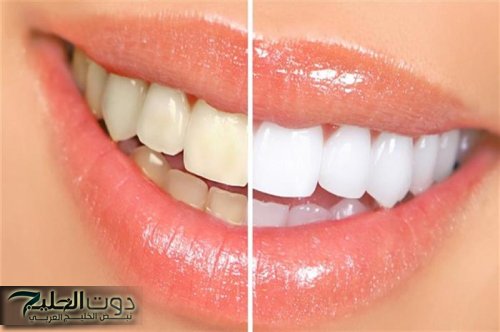 'مش هتحتاجي لجلسة واحدة'.. طريقة فعالة لتبييض الأسنان وإزالة الجير في البيت في دقيقتين فقط.. جربيها الآن