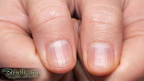 أمراض خطيرة جدًا هتعرفها من ضوافرك متخيل !!! خلي بالك ولو ظهرت هذه العلامات اكشف فورًا