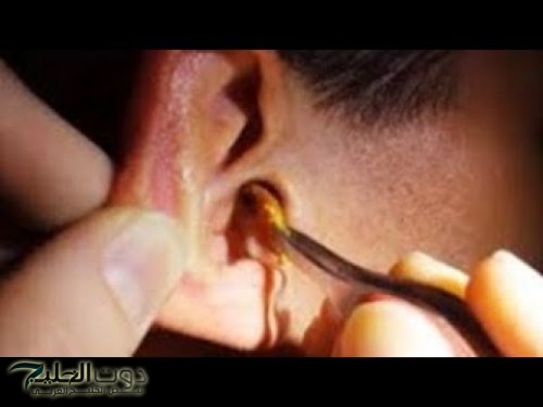 دكتور روسي قلي عليها.. !! أفضل طريقة لإزالة الشمع من الأذن بدون ألم وفي 5 دقائق فقط.. ياريتني كنت عرفتها من زمان!!