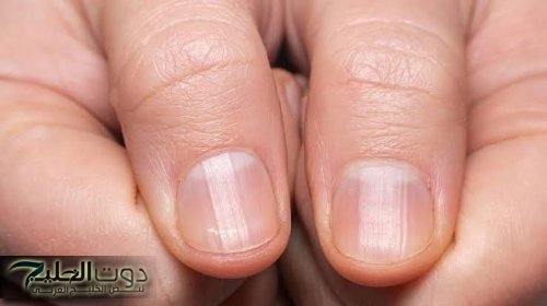 لو عندك العلامات دي صحتك في خطر.. احذروا من ظهور هذه العلامات على الأظافر تدل على الإصابة بأمراض خطيرة| أعرفها فوراً