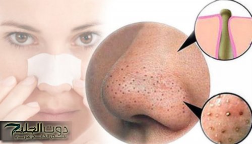 "وشك هينور من النضافة".. معجزة ربانية للتخلص من البثور السوداء بالنشا ومعجون الأسنان في ثواني وبدون أي مجهود.. فنانة كويتية تنصح الجميع بها !!