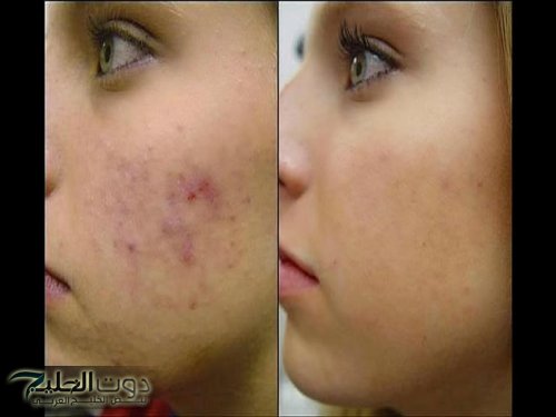 الحاجات دي مفيهاش هزار!!.. عادة خاطئة يفعلها الكثيرون عند التخلص من حب الشباب والطريقة الصحيحة للتخلص منه!!