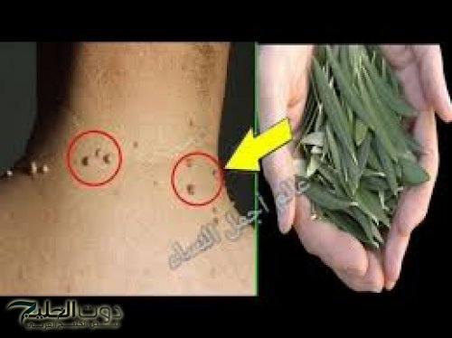 "بدون ألم أو خوف" .. استخدم أوراق هذه العشبة تقضي على الزوائد الجلدية أو الثالول للأبد دهنة واحدة يوميًا سيموت ويختفي