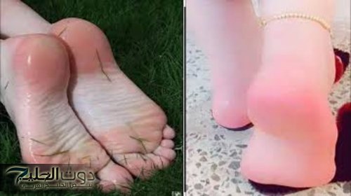 «اسحريهم بجمال خطوتك..!!» طريقة عبقرية للقضاء على التشققات الكعبين وازالة الخلايا الميته وتنعيم القدمين بسرعة.. ما تروحيش كوافير تاني..!!