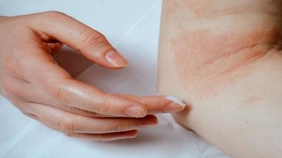 كيفية التمييز بين الجرب والإكزيما