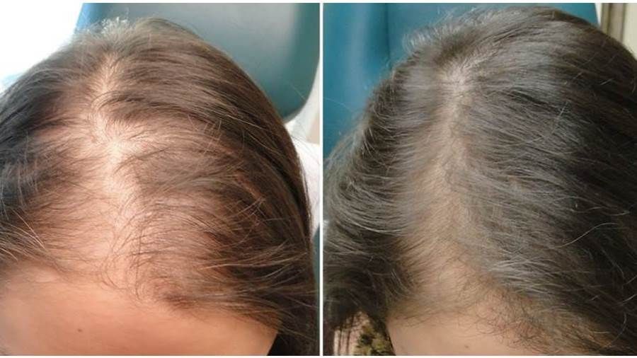 أمراض فروة الرأس الأكثر شيوعاً وكيفية علاجها