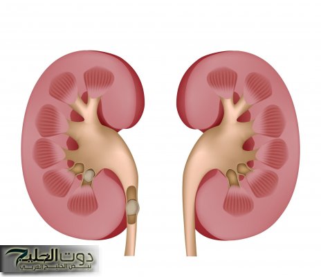"العشبة الربانية لتفتيت حصوات الكلى ومنع تكوينها مجددًا بدون ألم وبنتائج مذهلة في أيام!"