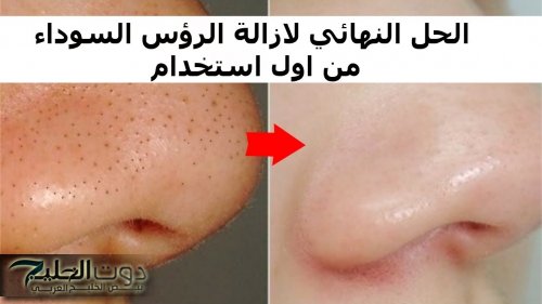 "النتبجة هتبهرك حرفيا".. وصفات لازالة الرؤوس السوداء من الوجه والانف بمكونات موجودة في رف المطبخ.. هتشكريني عليها!!