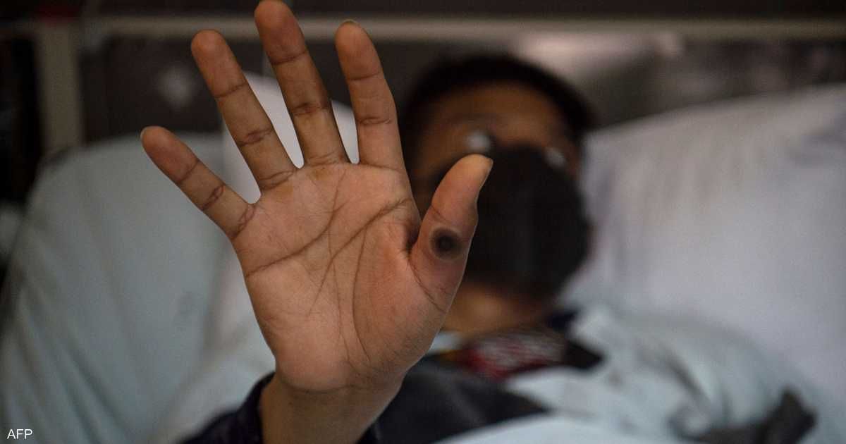 العالم اليوم - الولايات المتحدة تسجل أول إصابة بسلالة فرعية من جدري القردة