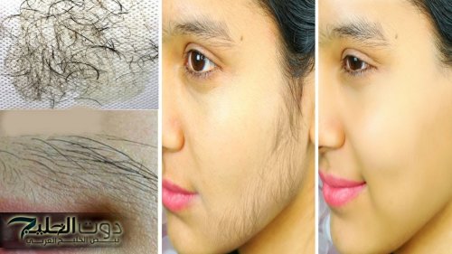 مكون اقوي من الليزر لإزالة شعر الوجه والجسم كله من الجذور وتبيض فوري للأماكن الغامقة