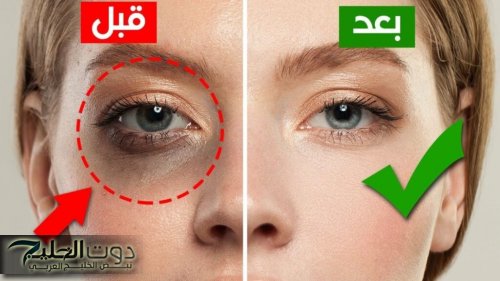 خليكي دائمًا مشرقة.. طريقة عمل قناع العسل لعلاج الهالات السوداء والاسمرار حول العين النتيجة مبهرة