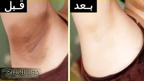 أنعم من الاطفال.. طريقة عمل قناع البطاطس لتبييض منطقة الإبطين والمناطق الحساسة والتخلص من السواد بسرعة الصاروخ