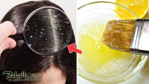 وصفات منزلية ..أضمن طرق طبيعية لعلاج فروة الرأس من الحكة والقشرة