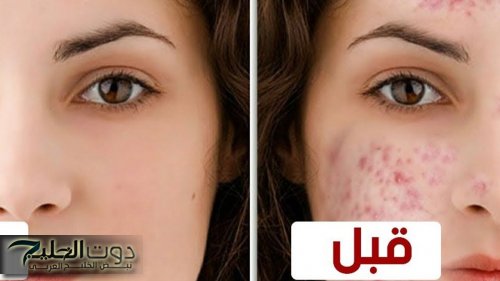علاج حب الشباب للبشرة الدهنية بمكون واحد فقط وبدون تكلفة