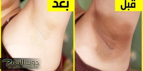 أنعم من الاطفال.. طريقة عمل قناع البطاطس لتبييض منطقة الإبطين والمناطق الحساسة والتخلص من السواد بسرعة الصاروخ