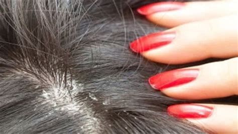 تفسير الدود في الشعر في المنام دود الشعر في الحلم