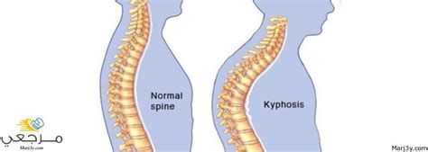 تفسير الاحدب في الحلم رؤية شخص احدب في المنام