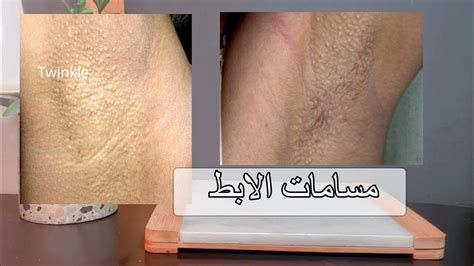 انتفاخ غدد الحليب تحت الإبط