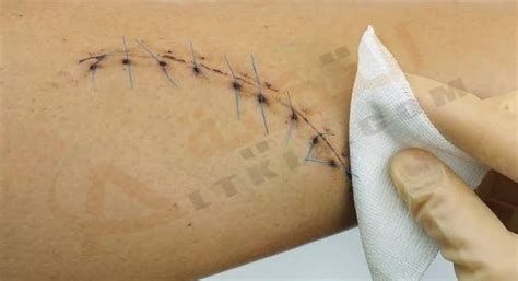 الجرح في المنام بدون دم