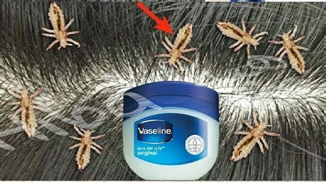 التخلص من البرد في يوم