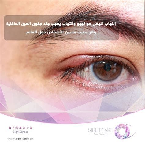 التخلص من انتفاخ العين نهائياً