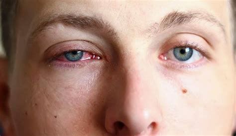 التخلص من انتفاخ العين نهائياً