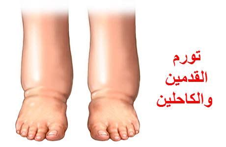 التخلص من انتفاخ العين نهائياً