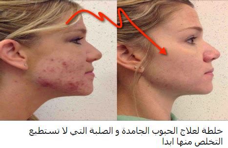 التخلص من انتفاخ العين نهائياً