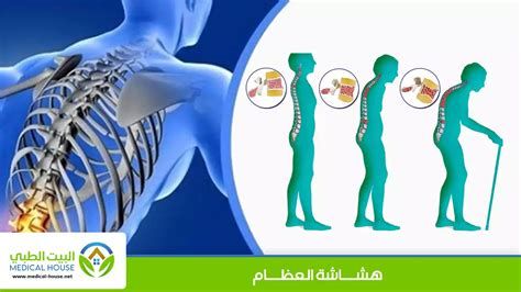 أفضل حبوب لهشاشة العظام