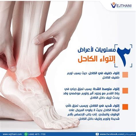 أفضل مسكن لآلام القدم